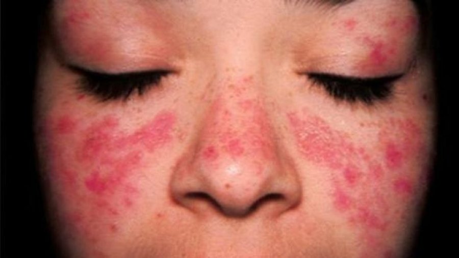 El lupus provoca erupciones en la piel de qui&eacute;nes la padecen