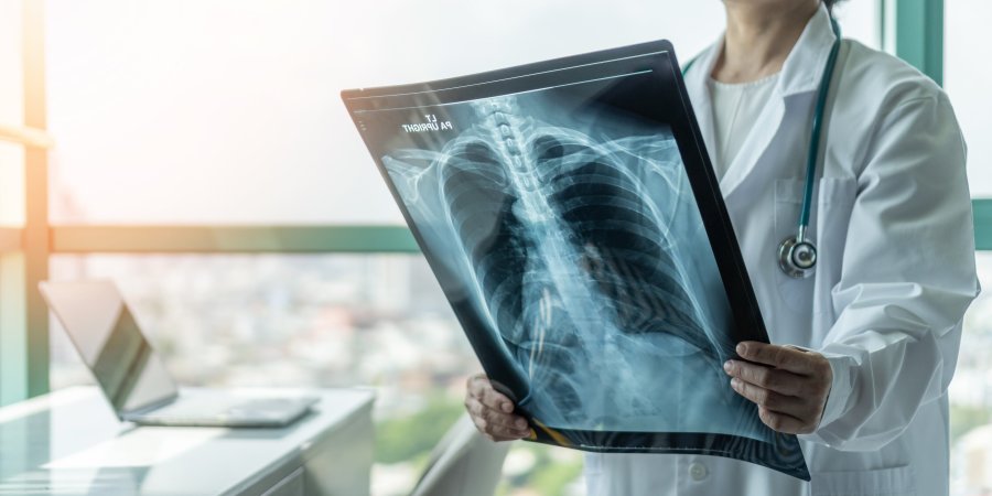 C&aacute;ncer de Pulm&oacute;n